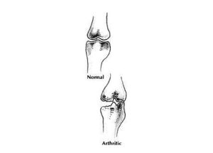 Geriatric Medicine: osteoarthritis (arthritis)